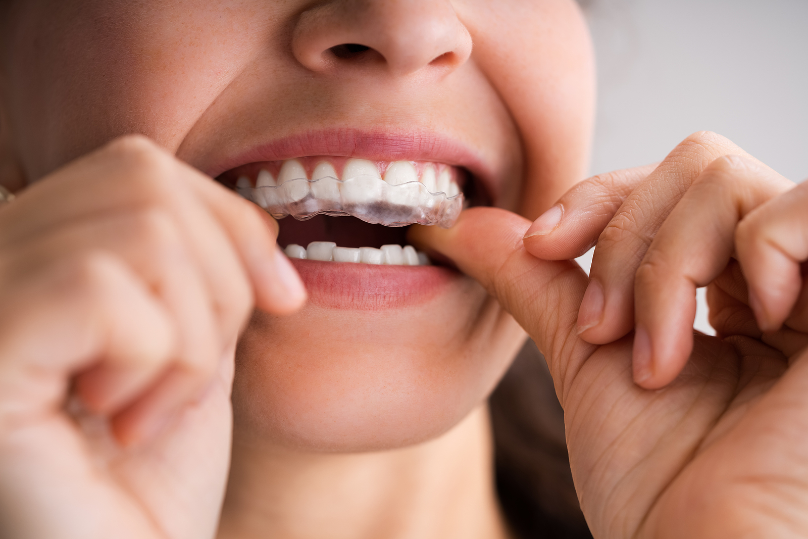 Straighten Your Smile and Address Major Dental Conditions with Invisalign Aligners